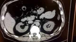 CT scan for kidney stone [upl. by Seedman489]