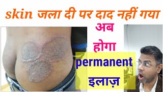 Fungal infection permanent treatment I Daad ka ilaj l Skin Care Clinic l Dr ANIL MOHITE l MD [upl. by Levina]