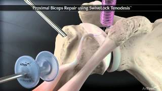 Proximal Biceps Repair using Arthrex SwiveLock® Tenodesis [upl. by Gretal565]