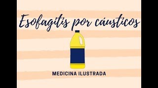 Esofagitis por Cáusticos [upl. by Izogn]