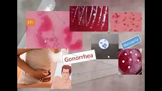 Gonorrhoea and isolation of its causative agent Neisseria STI Neisseria gonorrhoeae [upl. by Derrek]