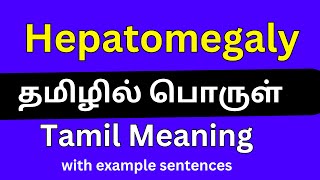 Hepatomegaly meaning in TamilHepatomegaly தமிழில் பொருள் [upl. by Nyliret272]