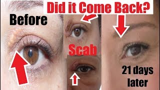 Has Xanthelasma Come Back Before amp After Xanthelasma Removal at Home I show My Scar after Removal [upl. by Nylsor607]