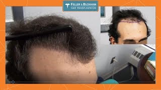 Young Hair Transplant Results  3000 Graft Hair Transplant  Feller amp Bloxham  NY NYC [upl. by Mushro]