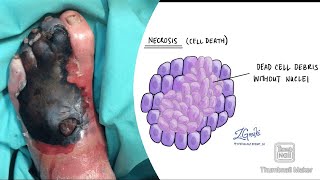 Necrosis and its types coagulative liquefactive caseous fat fibrinoid necrosis fmge neetpg [upl. by Eam366]