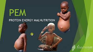 PEM protein energy malnutrition [upl. by Nnaoj217]