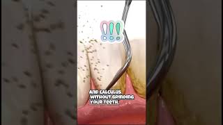 Scaling teeth ruin your tooth enamelWatch full video on our channelscalingteeth cleaning [upl. by Aivart]