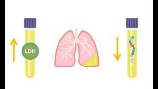 Differentiating transudative and exudative effusions transudate vs exudate [upl. by Arrekahs]