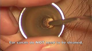 Ear Wax Extraction  St Pauls Hospital [upl. by Norraa]