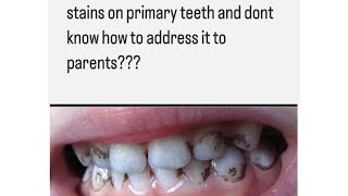 Stains on primary teeth and chromogenic bacteria dentisteducation dentistry indiandentist [upl. by Lathrope909]