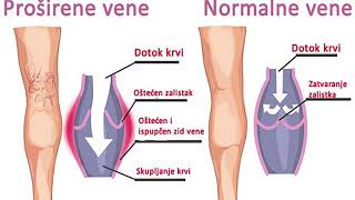 ODABERI ZDRAVLJE  PROBLEMI S VENAMA [upl. by Ahsyak]