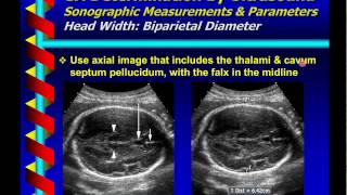 Gestational Age Determination by Ultrasound [upl. by Suolkcin]