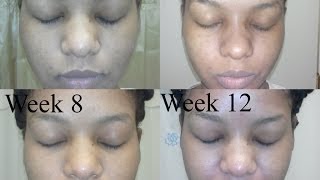 Kojic Acid Soap Before And After Honest Review week 12 collage [upl. by Gnaht394]