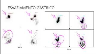 CINTILOGRAFIA ABDOMINAL [upl. by O'Connor744]