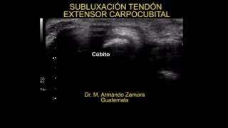 SUBLUXACIÓN DEL TENDÓN EXTENSOR CARPOCUBITAL [upl. by Inanak]