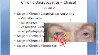 Ophthalmology 402 a Chronic DaCryoCystitis catarrhal mucocele suppurative fibrotic [upl. by Woodford]