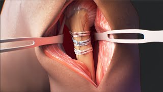 FiberTape® Cerclage System [upl. by Rexfourd770]