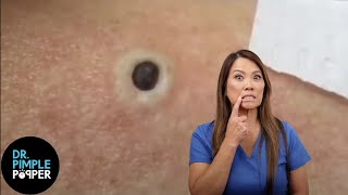 85 Year Old Blackhead Dr Pimple Popper Most Popular Pop of ALL TIME [upl. by Mashe]