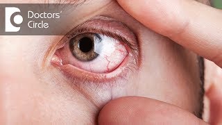 What causes visible red fine lines in eyes  Dr Elankumaran P [upl. by Yurik626]