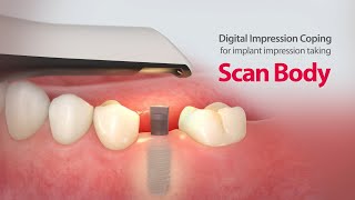 Digital Impression Coping for implant impression taking quotScanBodyquot [upl. by Neehsuan]