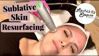 Sublative Laser Skin Resurfacing How To Get Rid Of Acne Scars [upl. by Lancey79]