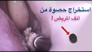 Rhinolith هل سمعت بحصوة الأنف من قبل؟ [upl. by Kirbie]