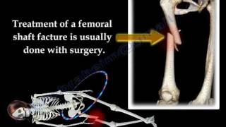 Fracture of the Femur and its fixation  Everything You Need To Know  Dr Nabil Ebraheim [upl. by Anaira]