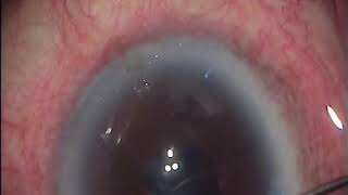 small pupil mature cataract phaco surgery [upl. by Anikahs]