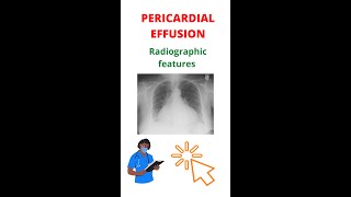 ✅ How To Diagnose Pericardial Effusion shorts xray [upl. by Allveta]