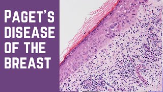 Pagets Disease of the Breast  Pathology mini tutorial [upl. by Harle]