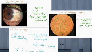 XEROPHTHALMIA  Vitamin A deficiency  ophthalmology  English  symptoms  treatment [upl. by Harle]