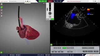 HeartWorks Atrial Septal Defect [upl. by Aenad578]