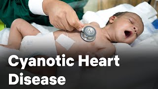 Cyanotic Heart Disease  Congenital  Cardiology  Neonatology  Graphic Era Hospital  GEIMS [upl. by Thetis]