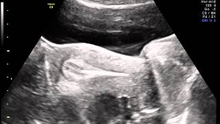 Ultrasound guided Embryo transfer [upl. by Enyalaj]