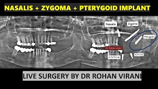 NASALIS  ZYGOMA  PTERYGOID IMPLANT  LIVE SURGERY BY DR ROHAN VIRANI [upl. by Yclehc]