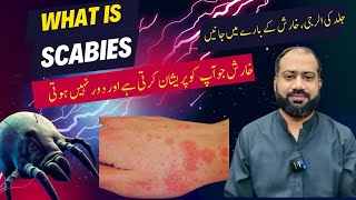 Scabies in Urdu  Kharish Ka ilaj  Skin allergy ka ilaj  Skin itching [upl. by Kajdan]