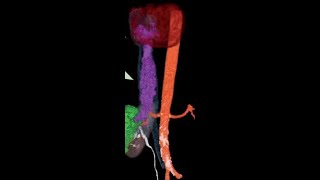 IVC leiomyosarcoma [upl. by Ybbil]