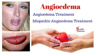 Angioedema  Angioedema Treatment  Idiopathic Angioedema Treatment [upl. by Euhsoj]