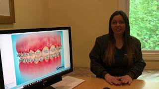 Decalcification of Teeth During Orthodontic Treatment [upl. by Eemiaj149]