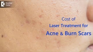 What is the cost of laser treatment for acne amp burn scars  Dr Rasya Dixit [upl. by Intirb555]