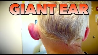 GIANT EAR Allergic Reaction or Infection  Dr Paul [upl. by Eisso]