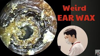 Ear wax removal 0914  Thick black Ear wax removal [upl. by Gnemgnok]