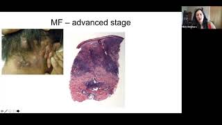 Pathology Grand Rounds  Cutaneous TCell Lymphoma  Dr Michi Shinohara [upl. by Debbee]