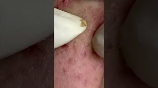 Big Cystic Acne Blackheads Extraction Blackheads amp Milia Whiteheads Removal Pimple Popping shorts [upl. by Erhard593]