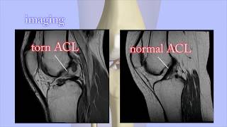 ACL Tears Diagnosis [upl. by Mcgurn755]