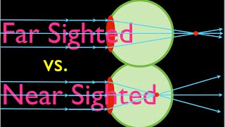 Farsighteness vs Nearsightedness An Explanation [upl. by Sander]