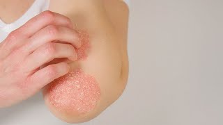 Tratamientos para la psoriasis [upl. by Eudo]