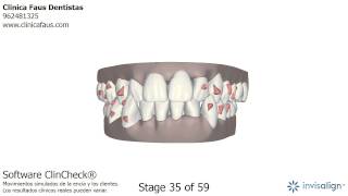 Clase III tratada con ortodoncia invisible Invisalign [upl. by Birecree]