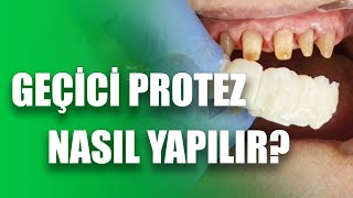 Klinikte Geçici Protez Nasıl Yapılır Ağız İçinde Geçici Protez Nasıl Yapılır [upl. by Curren]