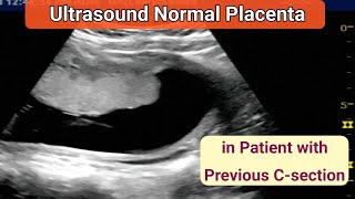 Ultrasound Normal Placenta  in Patient with Previous C Section [upl. by Oigaib25]